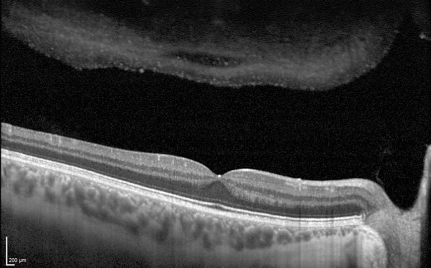 SD-OCT — corte retiniano de alta resolução