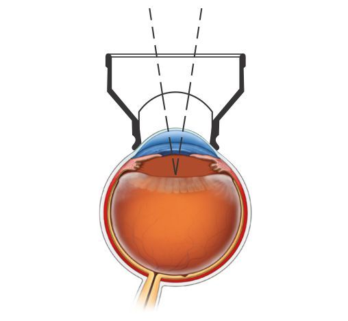 YAG Capsulotomy, detalhe