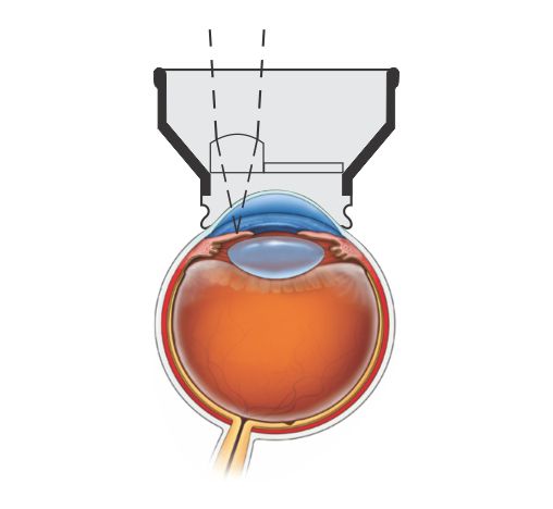 YAG Iridectomy, detalhe