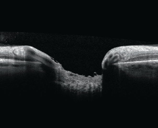 Segmento Anterior, OCT do ângulo da câmara anterior