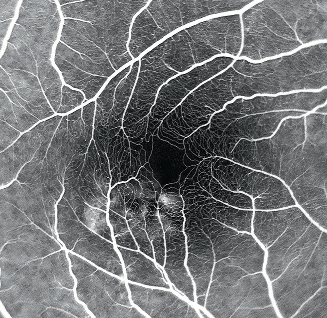 ICGA, angiografia com verde de indocianina