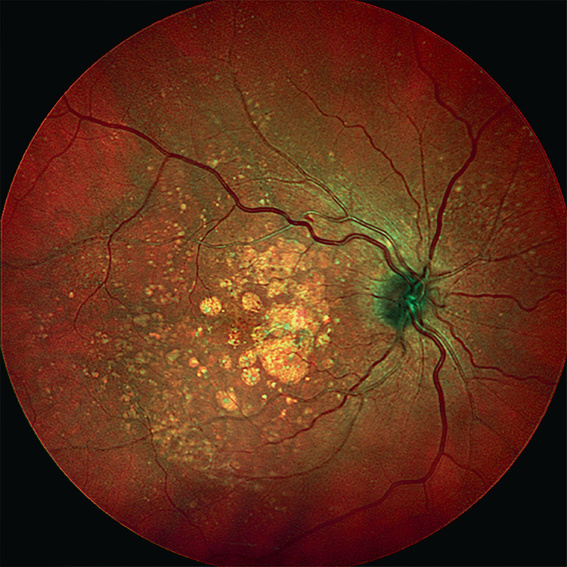 MultiColor, imagem multiespectral da retina