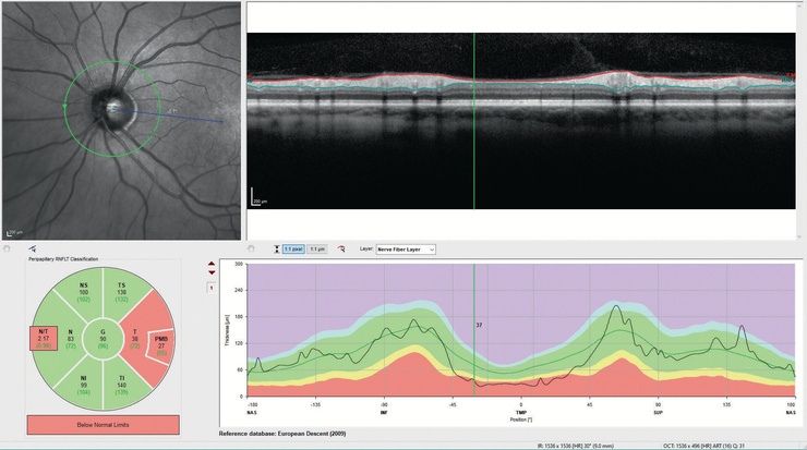 Nsite Analytics, análise de perda axonal