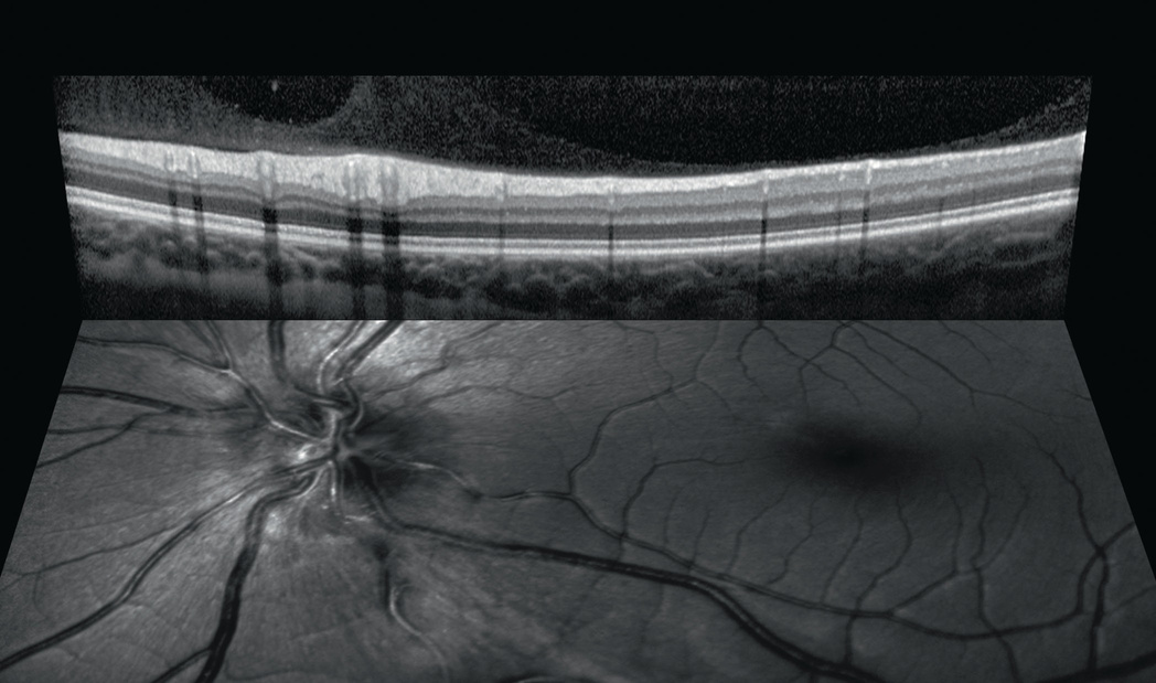 SD-OCT + SLO, corte retiniano e fundo de olho simultâneos