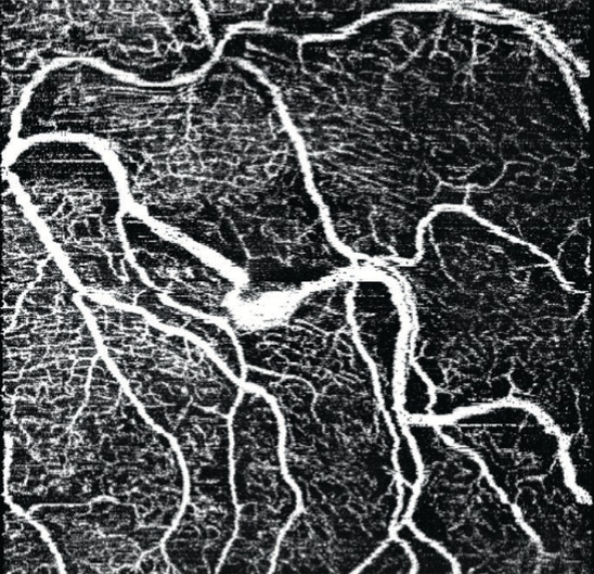 OCT Angiography, plexo vascular retiniano