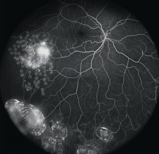 Ultra-Widefield, angiografia de campo ultra-amplo