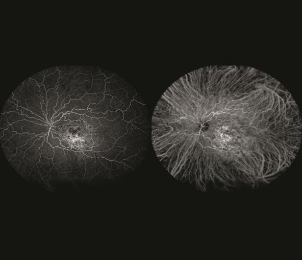 Scanning Laser Angiography — FA e ICGA simultâneos
