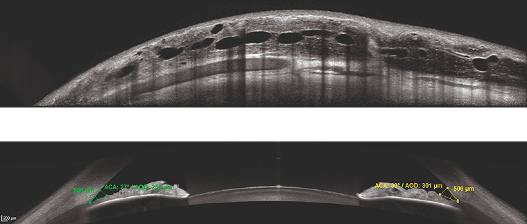 Anterior Segment Module — OCT de córnea e câmara anterior
