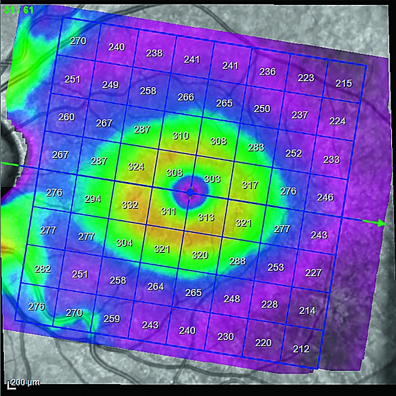 Glaucoma Module Premium Edition, Hood Report