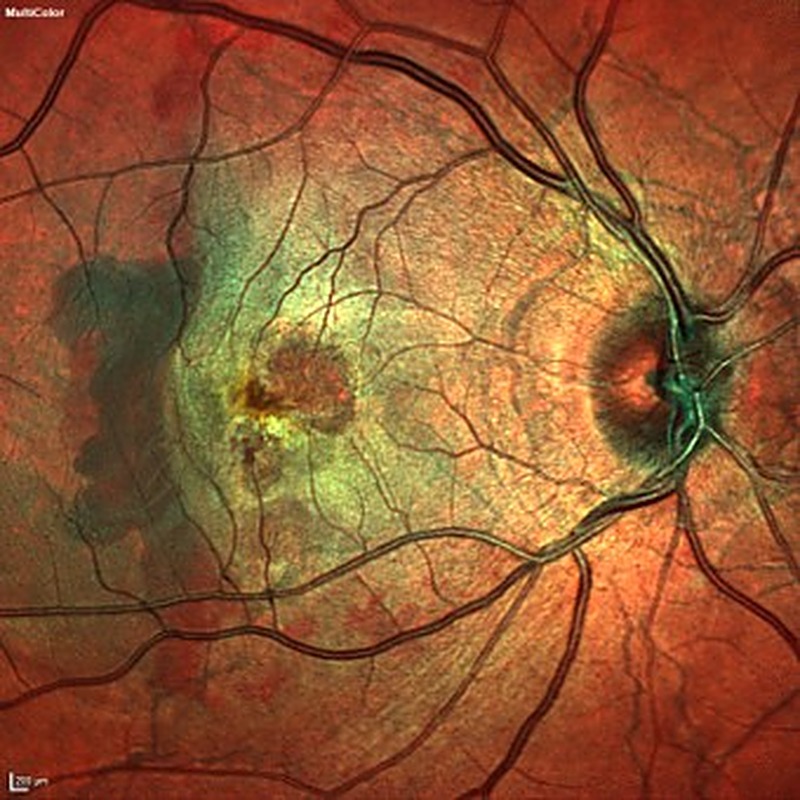 MultiColor, imagem multiespectral da retina