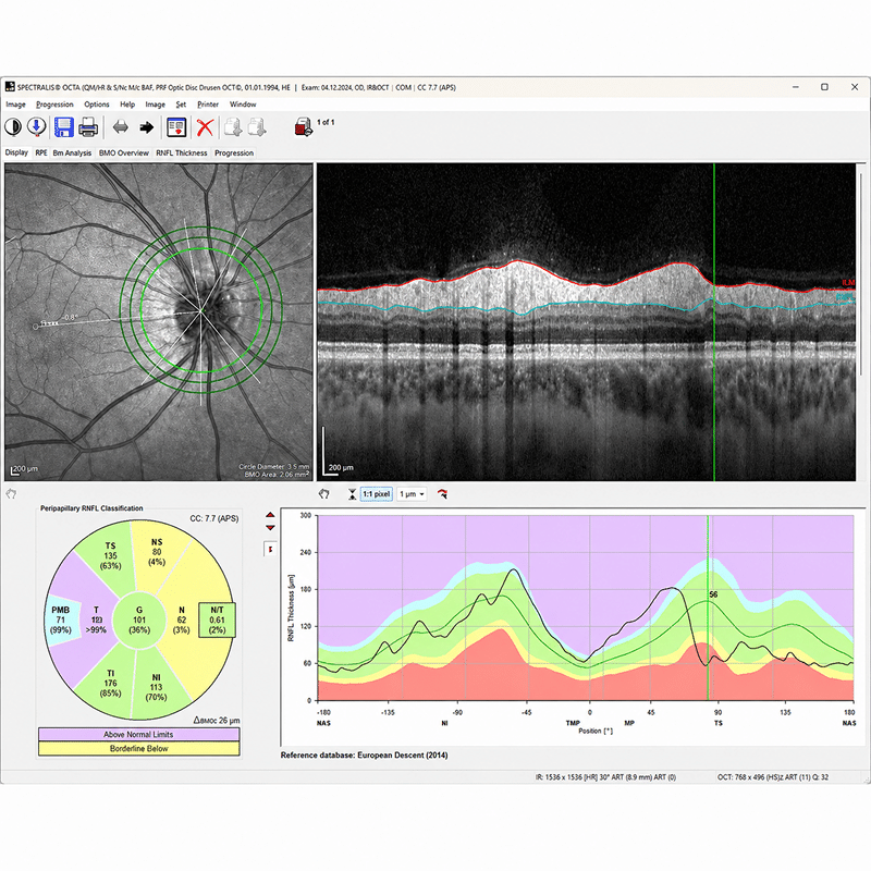 Nsite Analytics, análise de perda axonal