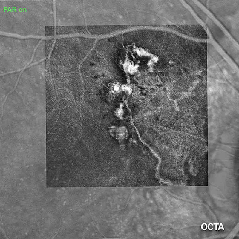 OCT Angiography, plexo vascular retiniano