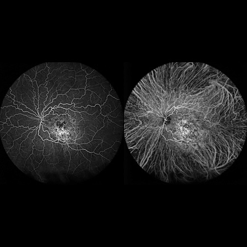Scanning Laser Angiography — FA e ICGA simultâneos