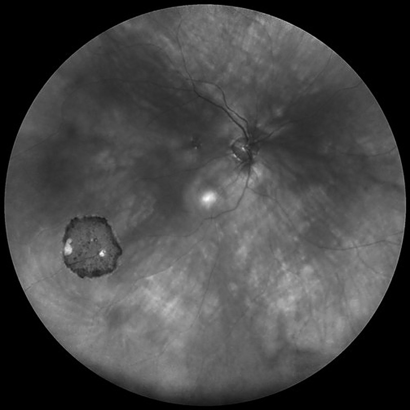 Ultra-Widefield, angiografia de campo ultra-amplo